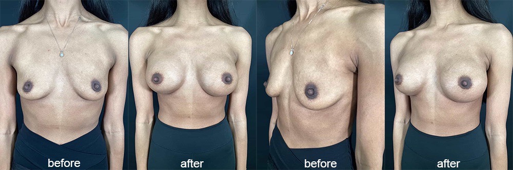 breast augmentation before and afters 1