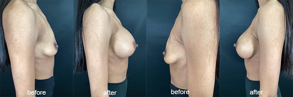 breast augmentation before and afters 2
