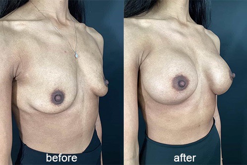 breast augmentation before and afters 3