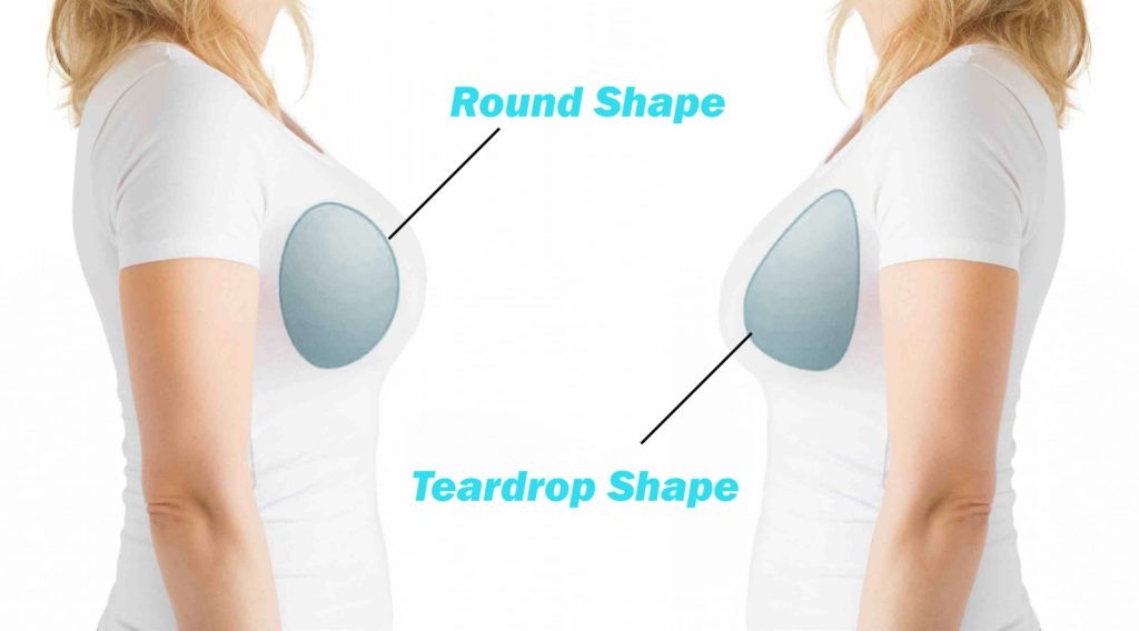 What Type of Breast Implant is the Most Natural-Looking?