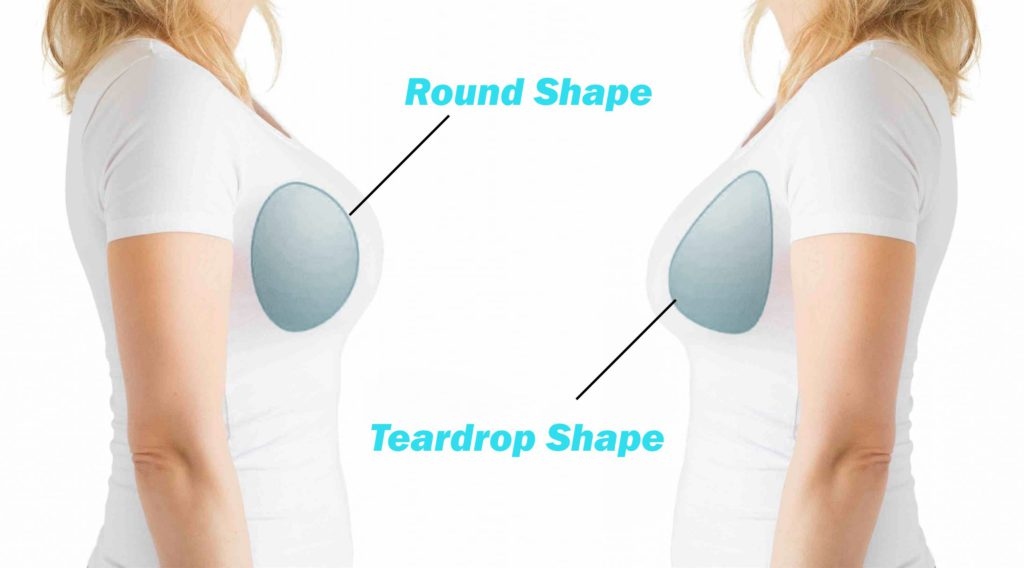 Most Natural Breast Augmentation: Round Implants or Teardrop? - Palms