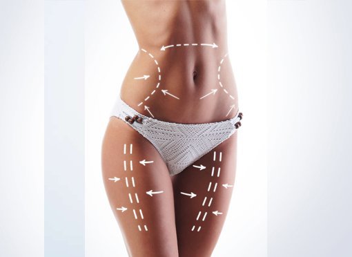 liposuction patient model wearing white bikini bottoms