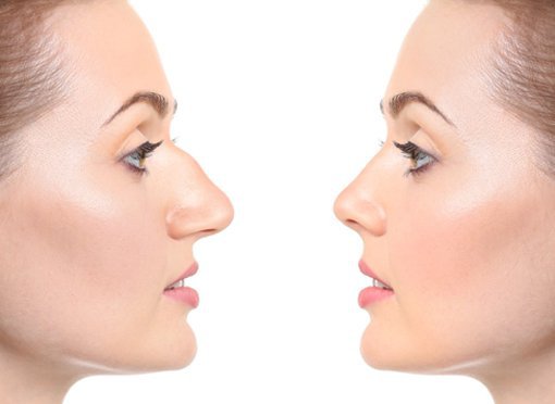 rhinoplasty patient model before and after