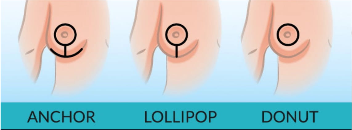 Chicago Breast Lift Incisions
