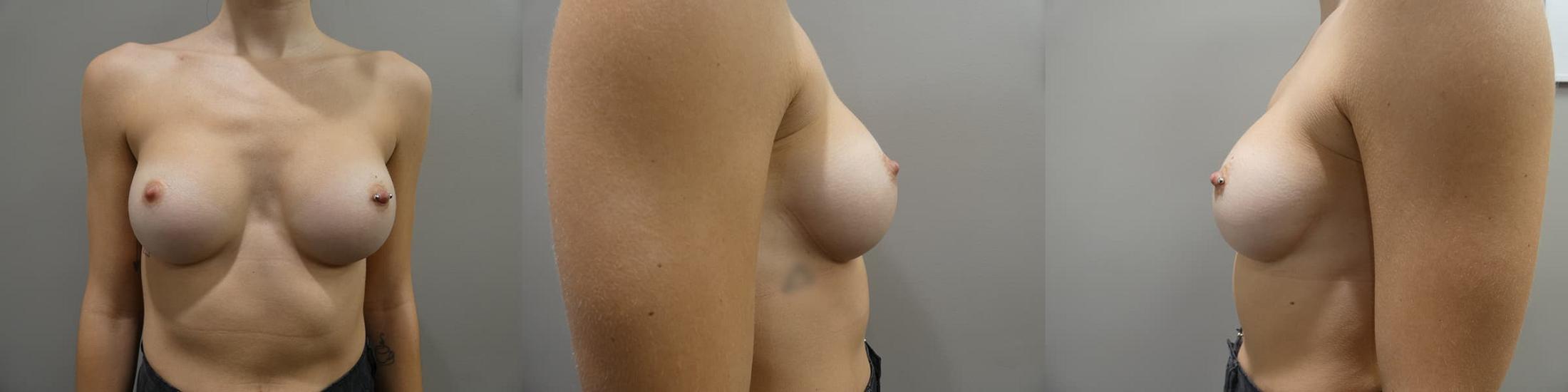 Breast Augmentation Before and After Post Op 1 Year
