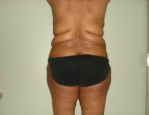 Back Fold Excision Before & After Image