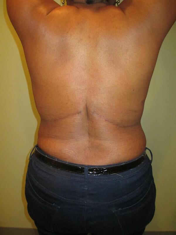 Back Fold Excision Before & After Image