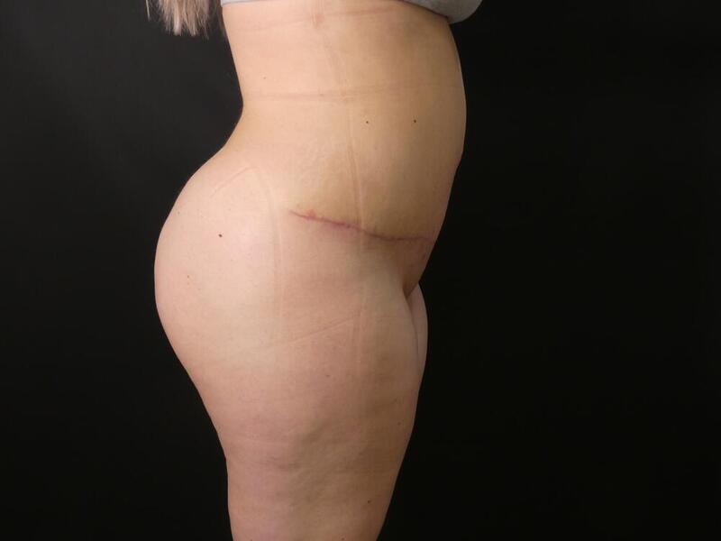 Brazilian Butt Lift Before & After Image