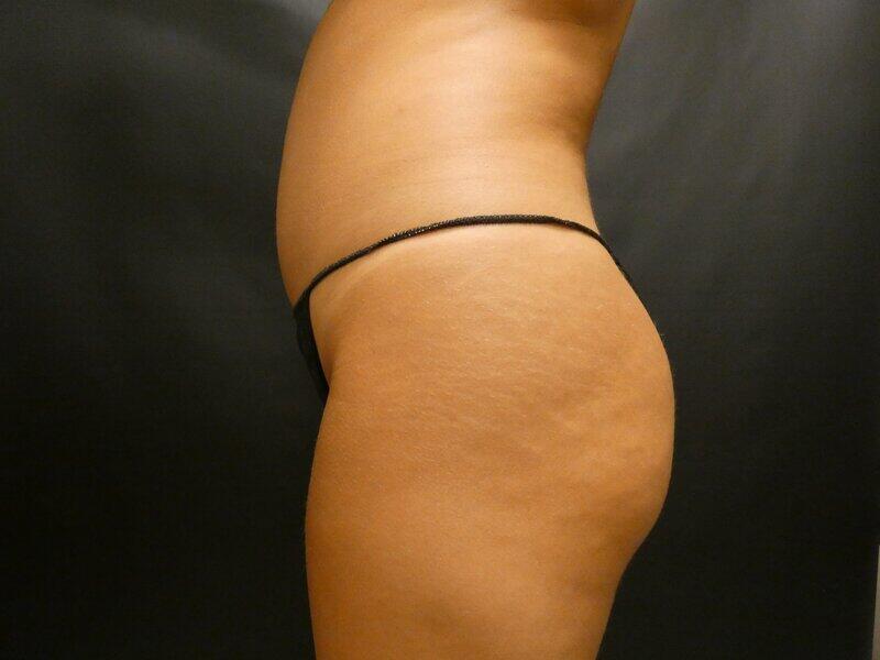 Brazilian Butt Lift Before & After Image