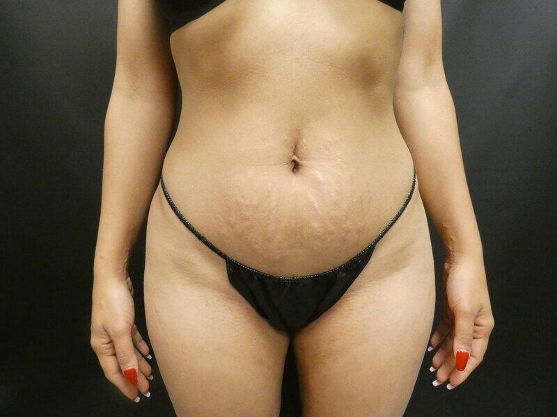 Brazilian Butt Lift Before & After Image