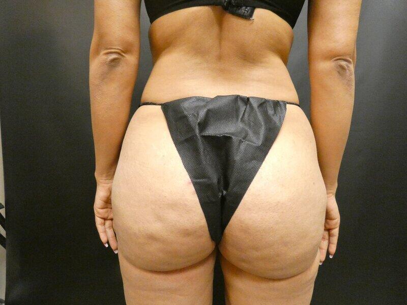 Brazilian Butt Lift Before & After Image