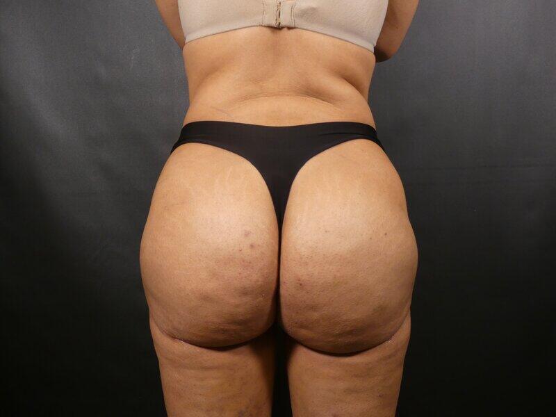 Brazilian Butt Lift Before & After Image