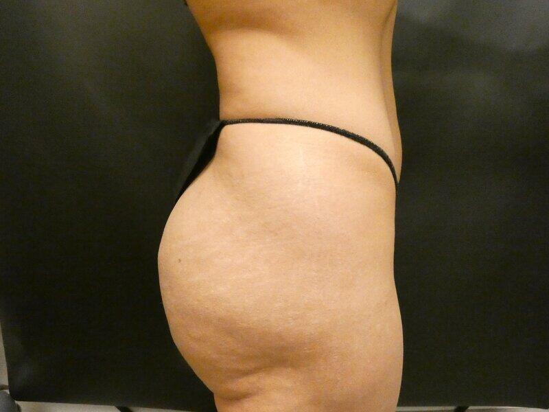 Brazilian Butt Lift Before & After Image