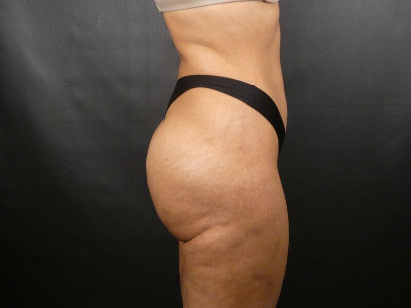 Brazilian Butt Lift Before & After Image