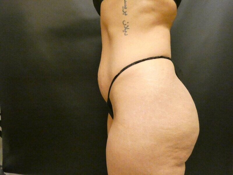 Brazilian Butt Lift Before & After Image