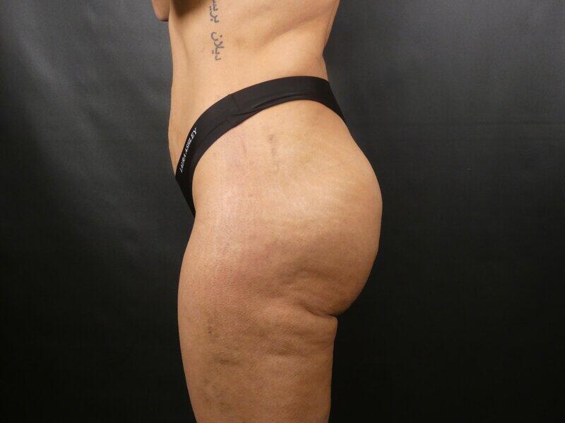 Brazilian Butt Lift Before & After Image