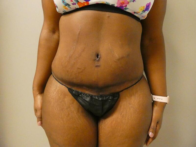 Liposuction Before & After Image