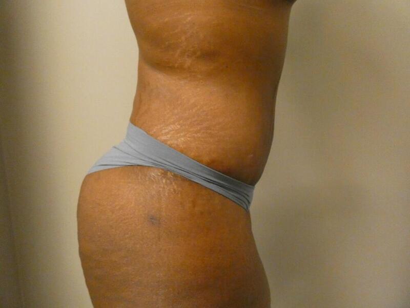 Liposuction Before & After Image