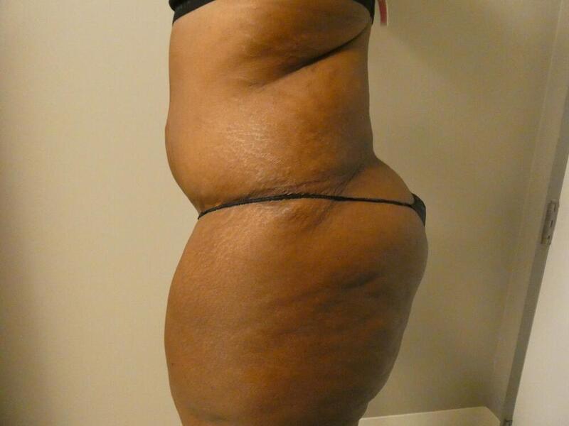 Liposuction Before & After Image