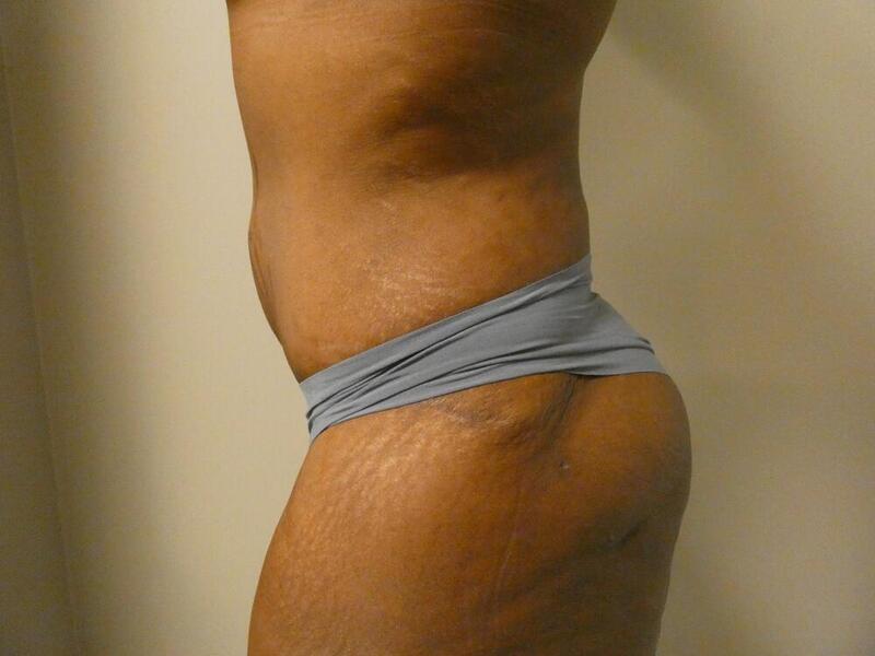 Liposuction Before & After Image