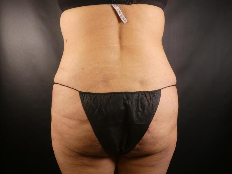 Liposuction Before & After Image