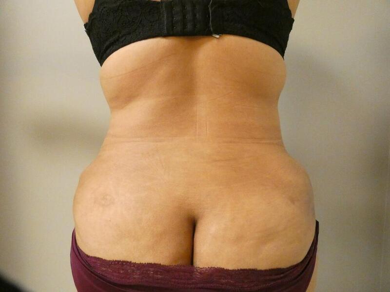 Liposuction Before & After Image