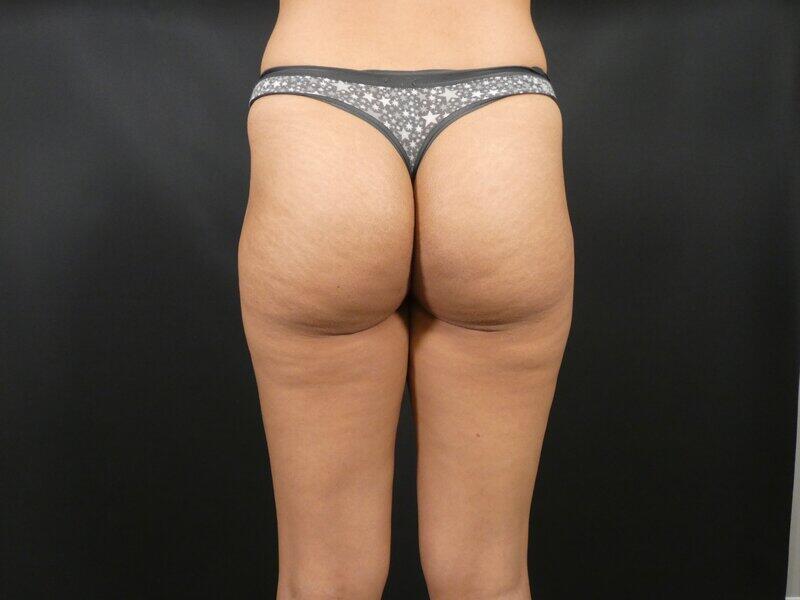 Liposuction Before & After Image