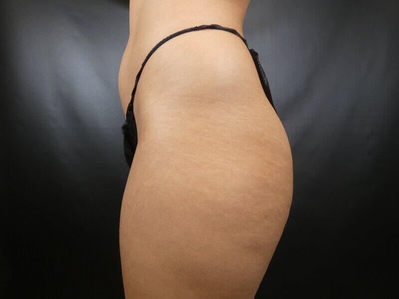 Liposuction Before & After Image