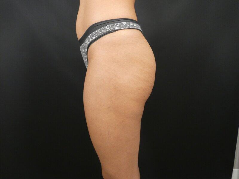 Liposuction Before & After Image