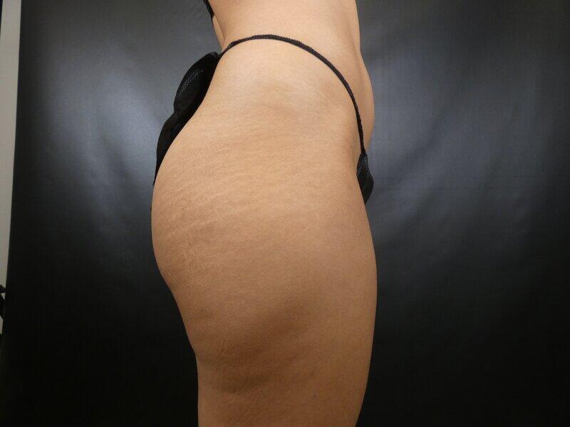 Liposuction Before & After Image