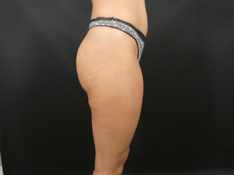 Liposuction Before & After Image