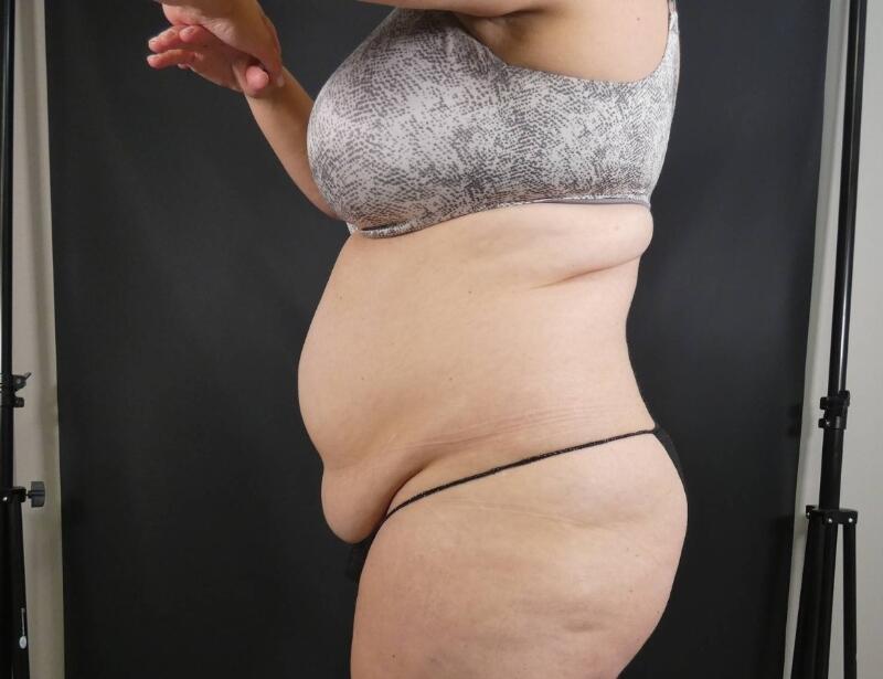 Tummy Tuck Before & After Image