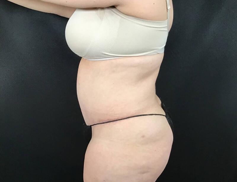 Tummy Tuck Before & After Image