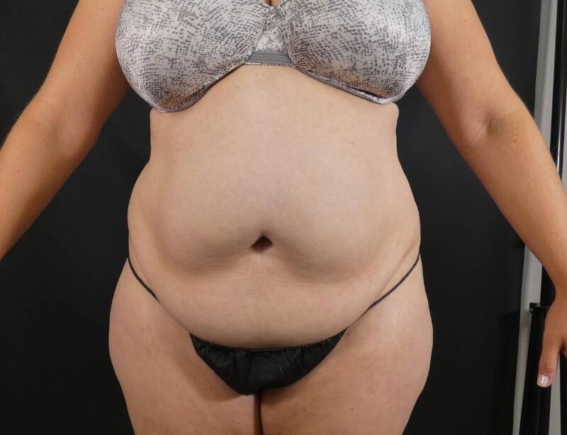 Tummy Tuck Before & After Image