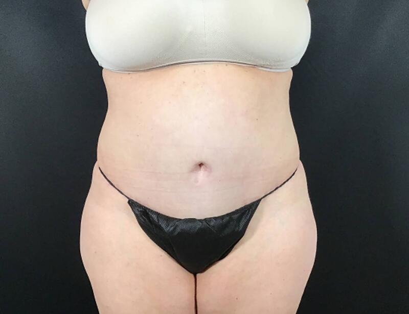 Tummy Tuck Before & After Image