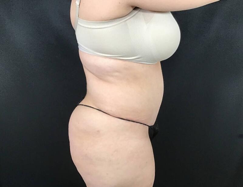 Tummy Tuck Before & After Image