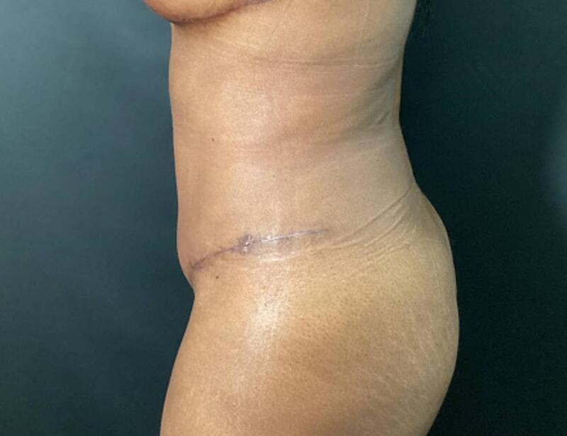 Tummy Tuck Before & After Image