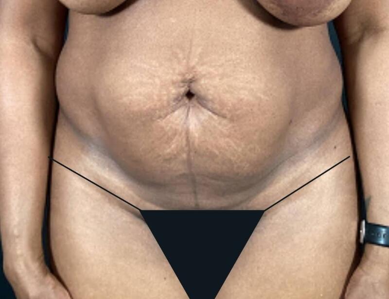 Tummy Tuck Before & After Image