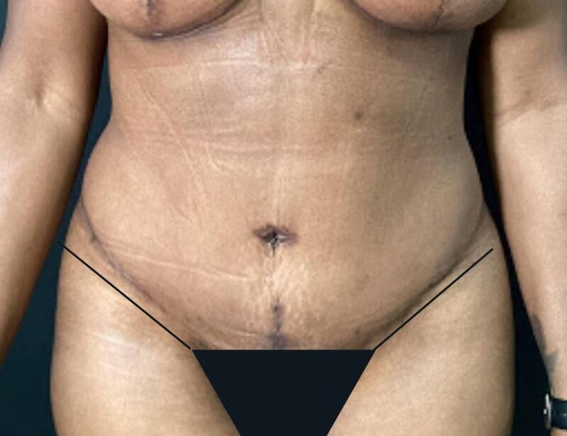 Tummy Tuck Before & After Image