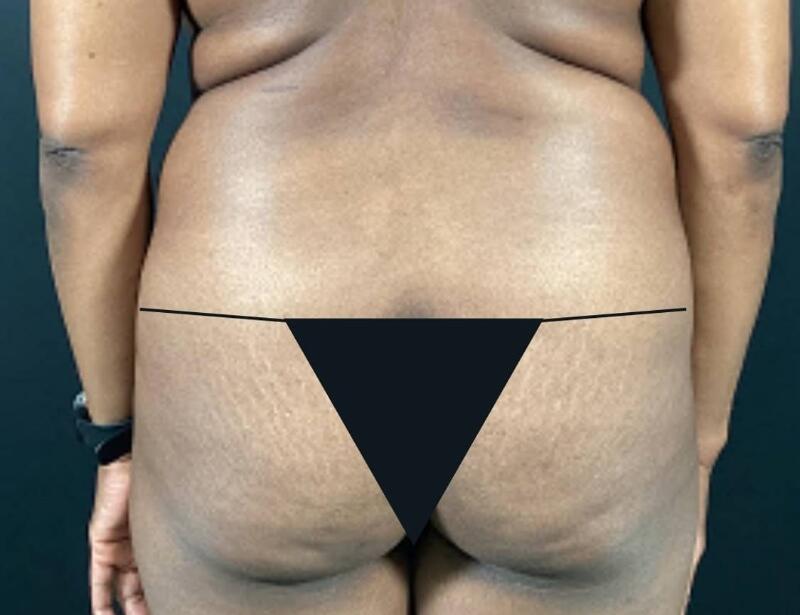 Tummy Tuck Before & After Image