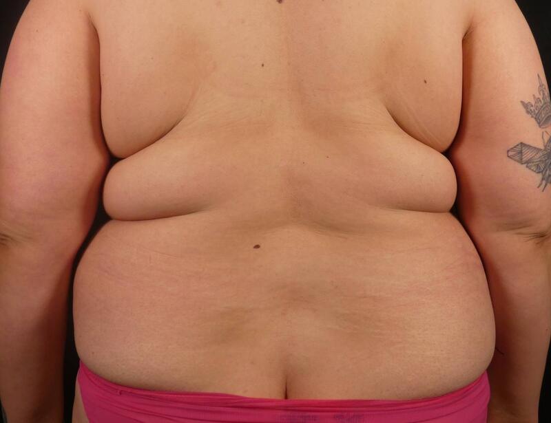 Tummy Tuck Before & After Image