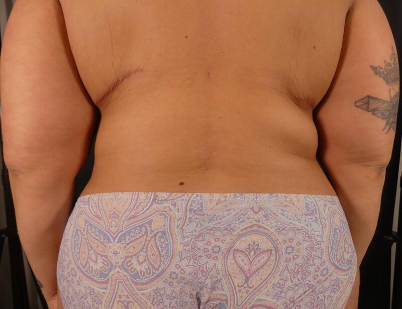 Tummy Tuck Before & After Image