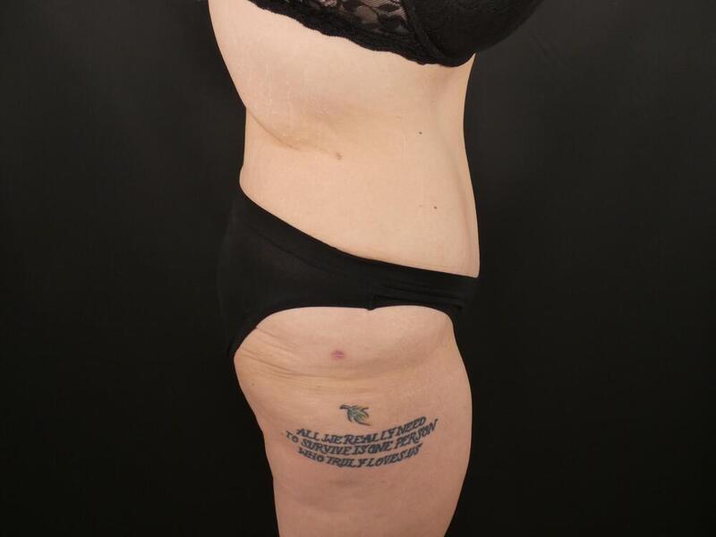 Tummy Tuck Before & After Image