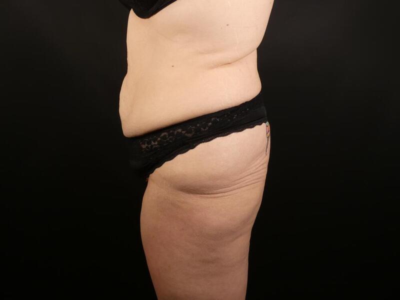 Tummy Tuck Before & After Image