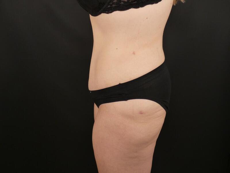 Tummy Tuck Before & After Image