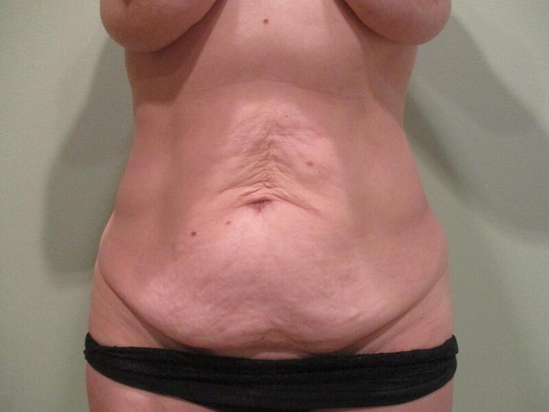 Tummy Tuck Before & After Image