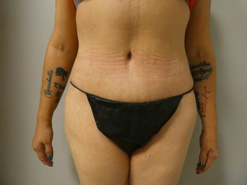 Tummy Tuck Before & After Image