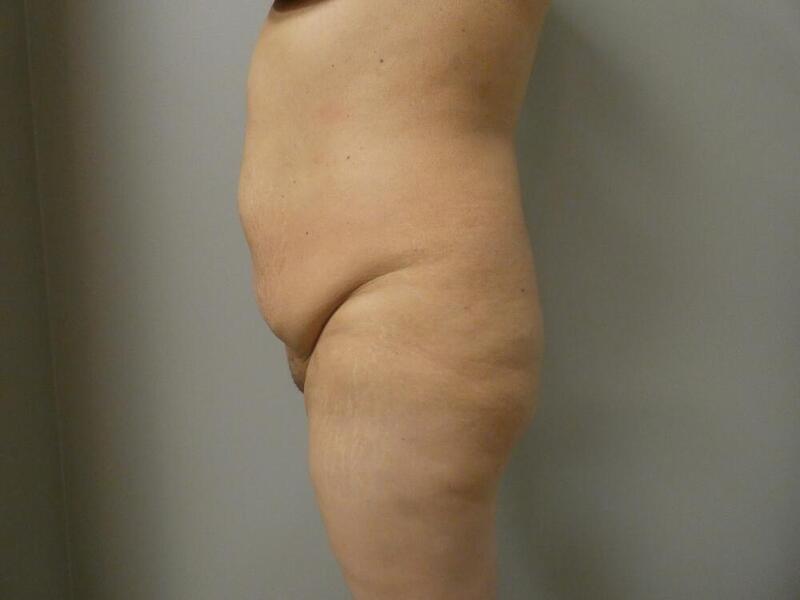 Tummy Tuck Before & After Image