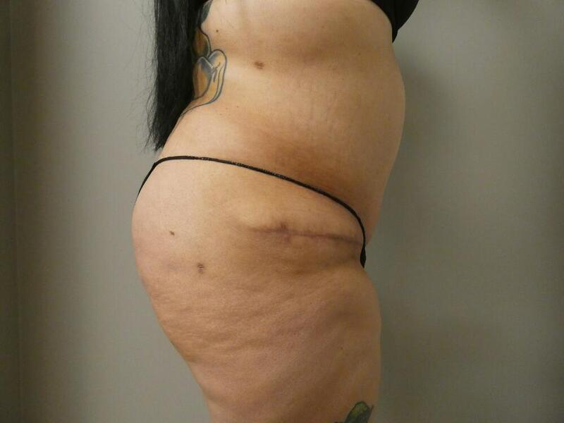 Tummy Tuck Before & After Image