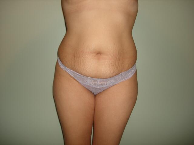 Tummy Tuck Before & After Image